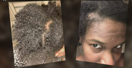 Black woman showing some bald patches in her scalp. 